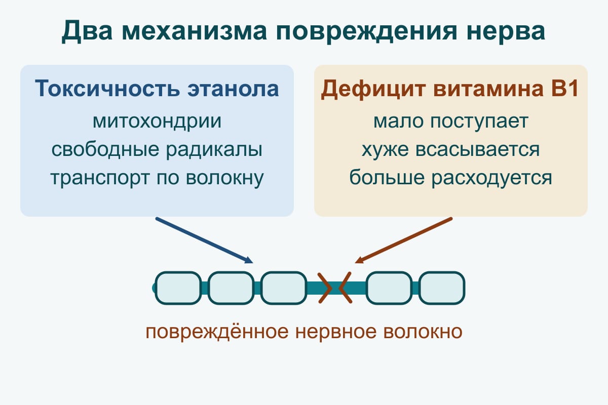 Схема: два механизма повреждения нерва — прямая токсичность этанола (митохондрии, свободные радикалы, транспорт) и дефицит витамина B1 (мало поступает, хуже всасывается, больше расходуется)